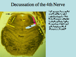 Decussation of the 4th Nerve