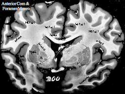 Anterior Commissure & Foramen Monro