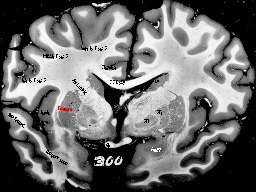 Temporal Pole Pre Anterior Commissure 