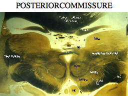 POSTERIOR COMMISSURE