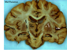 Mid-thalamus