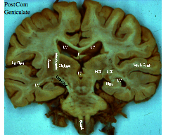 Posterior Commisure & Geniculates