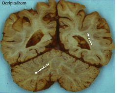 Occipital Horn