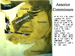 Anterior Commissure